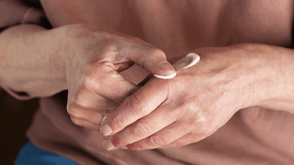 Topical Corticosteroid Potencies: How to Choose the Right Strength