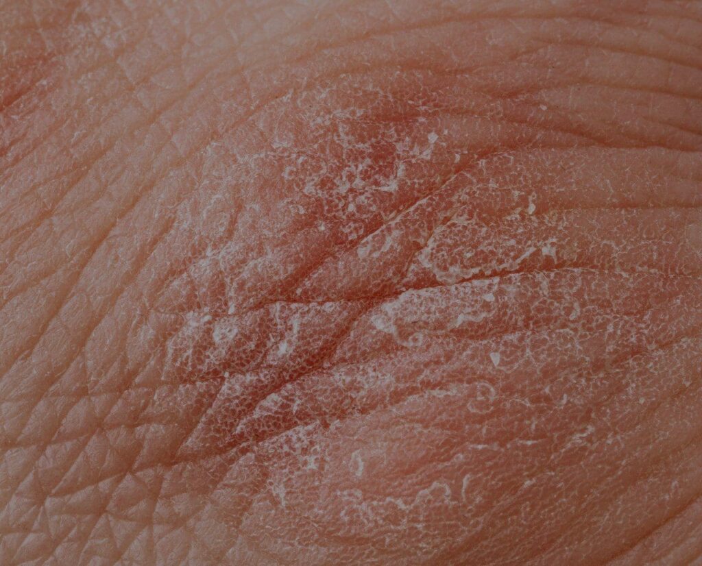 Eczema: Definition and Treatment Options