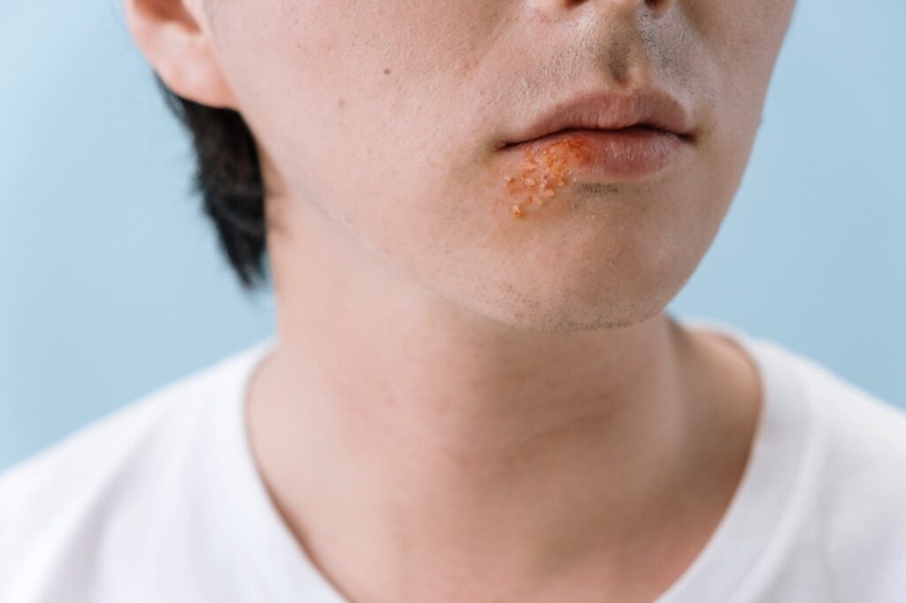 Acyclovir vs. Valacyclovir: Uses, Dosages, and Differences
