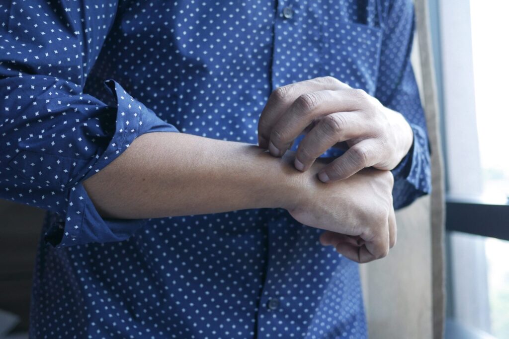 Do I Have Scabies? Symptoms, Diagnosis, and Treatment